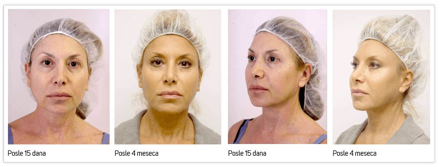 Silhouette Soft efekat