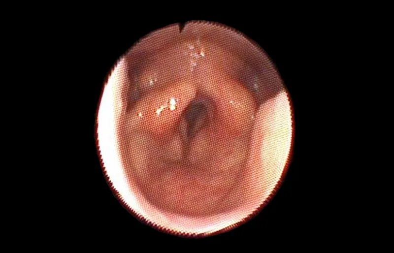Endoskopija Beograd - endoskopski snimak glasnica