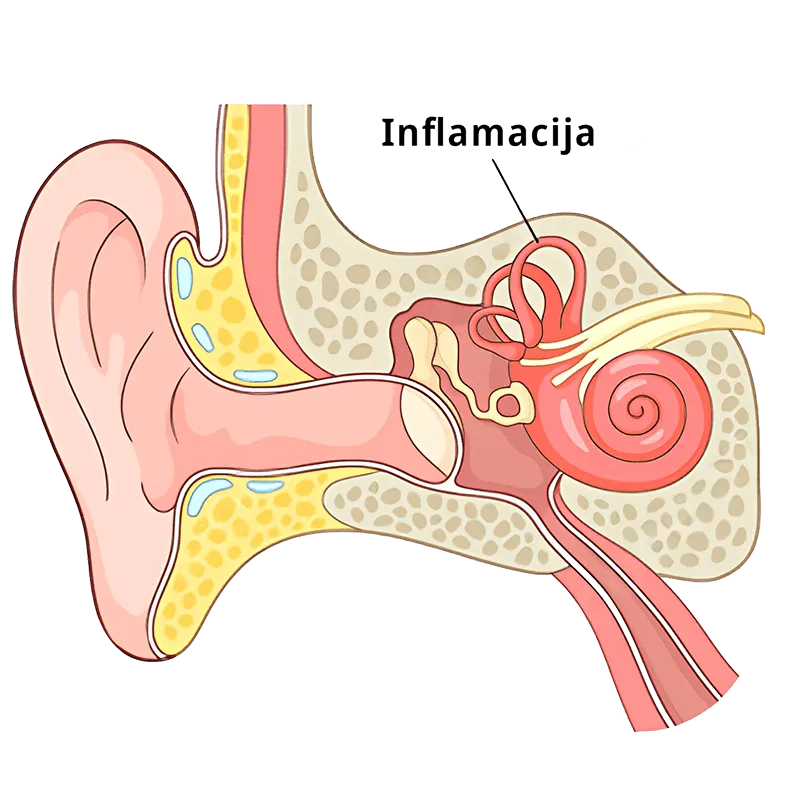 Otitis interna – Upala unutrašnjeg uva