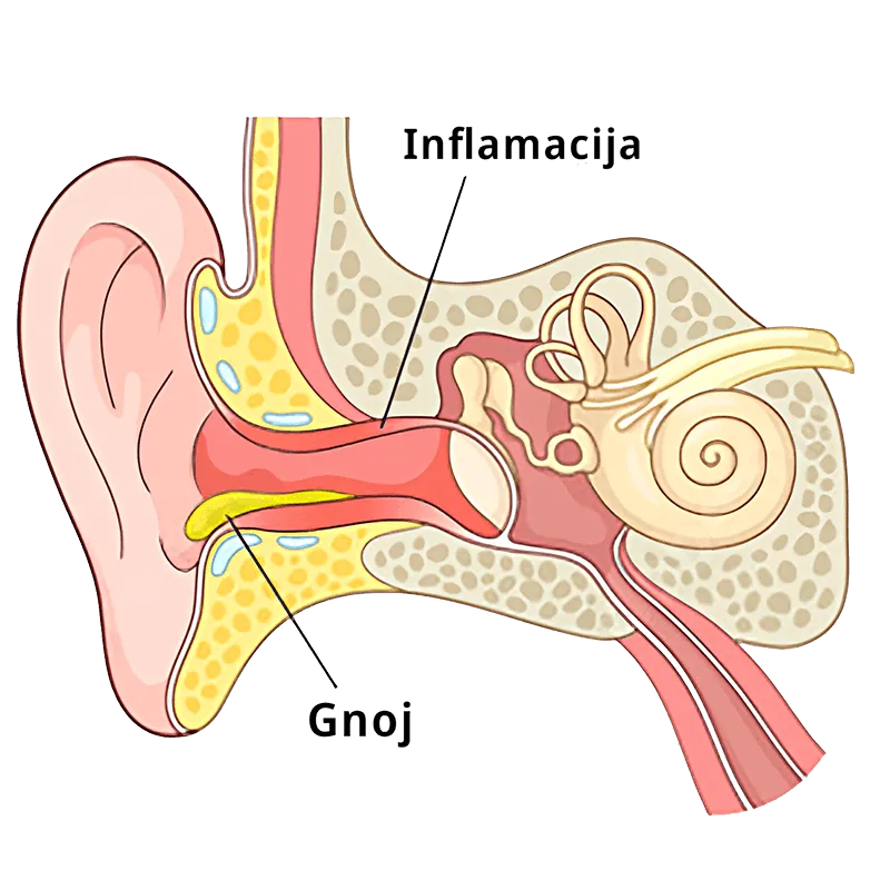 Otitis eksterna – Upala spoljašnjeg uva