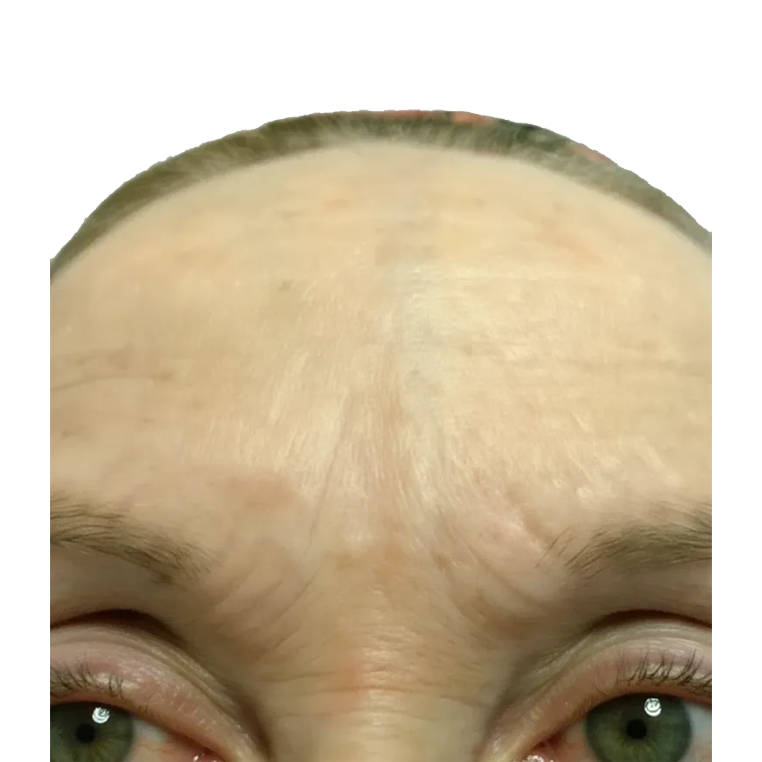 Botoks glabele posle tretmana – ublažene mrštilice u MKM ordinaciji Beograd