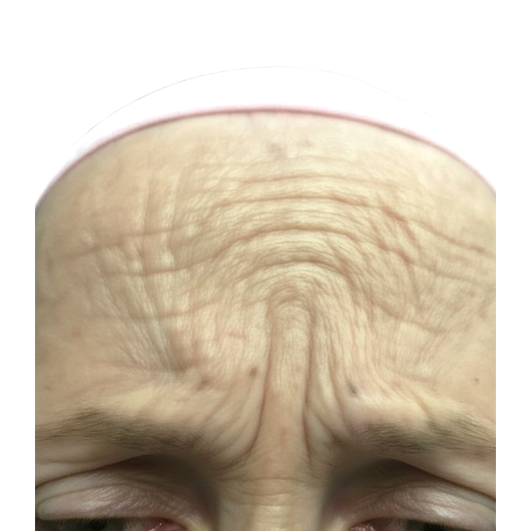 Botoks glabele pre tretmana – izražene mrštilice u MKM ordinaciji Beograd