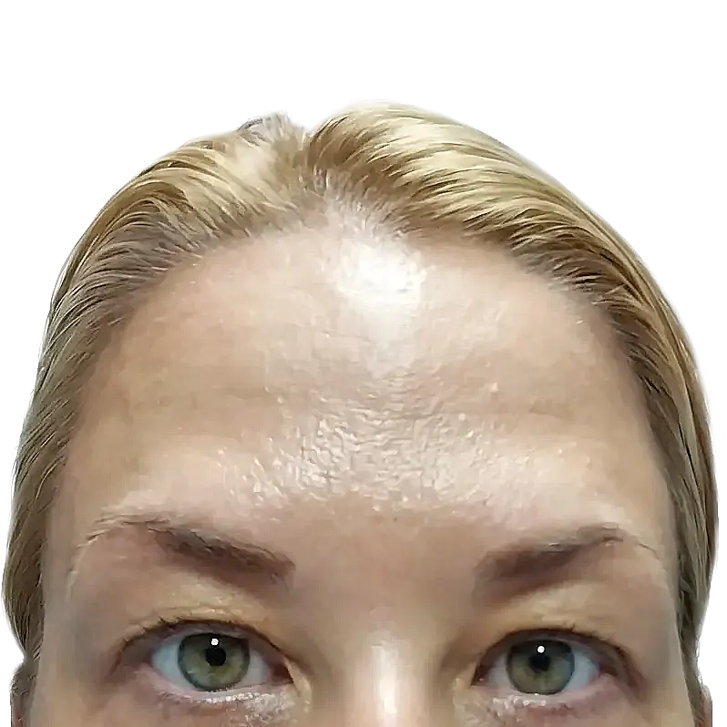 Botoks čelo posle tretmana – zaglađena koža i prirodan izgled Beograd