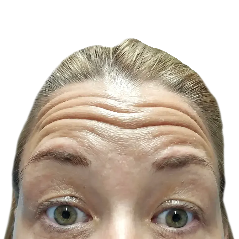 Botoks čelo pre tretmana – izražene horizontalne bore Beograd