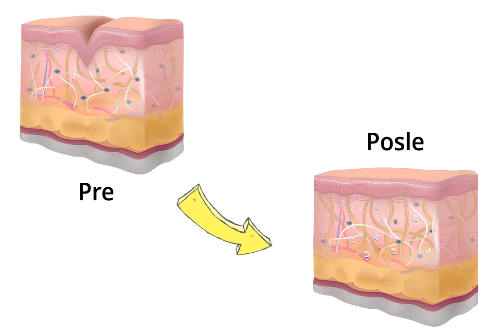 Kako hijaluronski fileri deluju u koži Delovanje hijaluronskih filera u koži – popunjavanje bora i obnova volumena lica