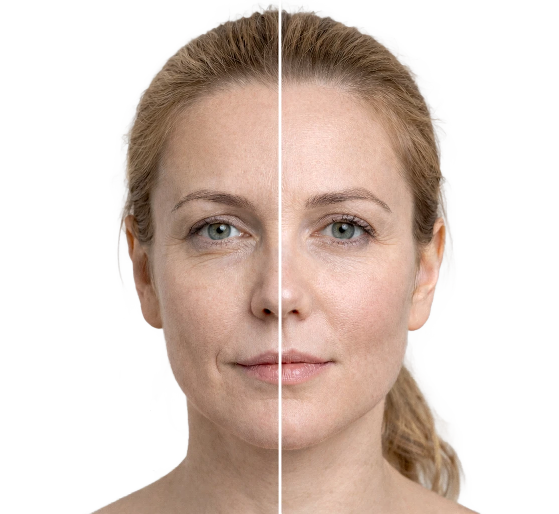 Hijaluronski fileri – pre i posle tretmana Pre i posle prikaz efekta hijaluronskih filera na licu i usnama – prirodna korekcija volumena